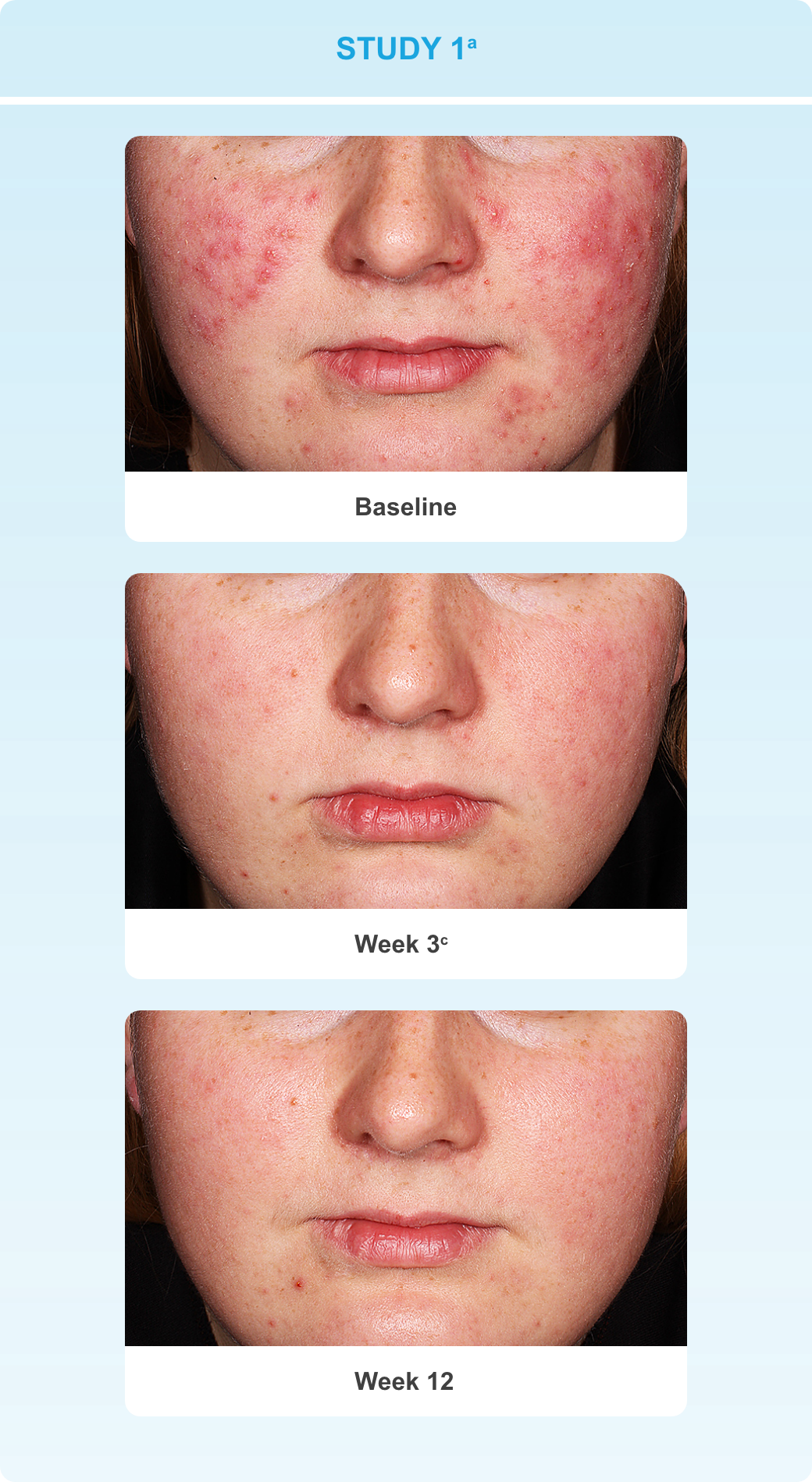 Series showing progressive reduction in lesions on a subject's face at baseline, week 3 and week 12 in study 1