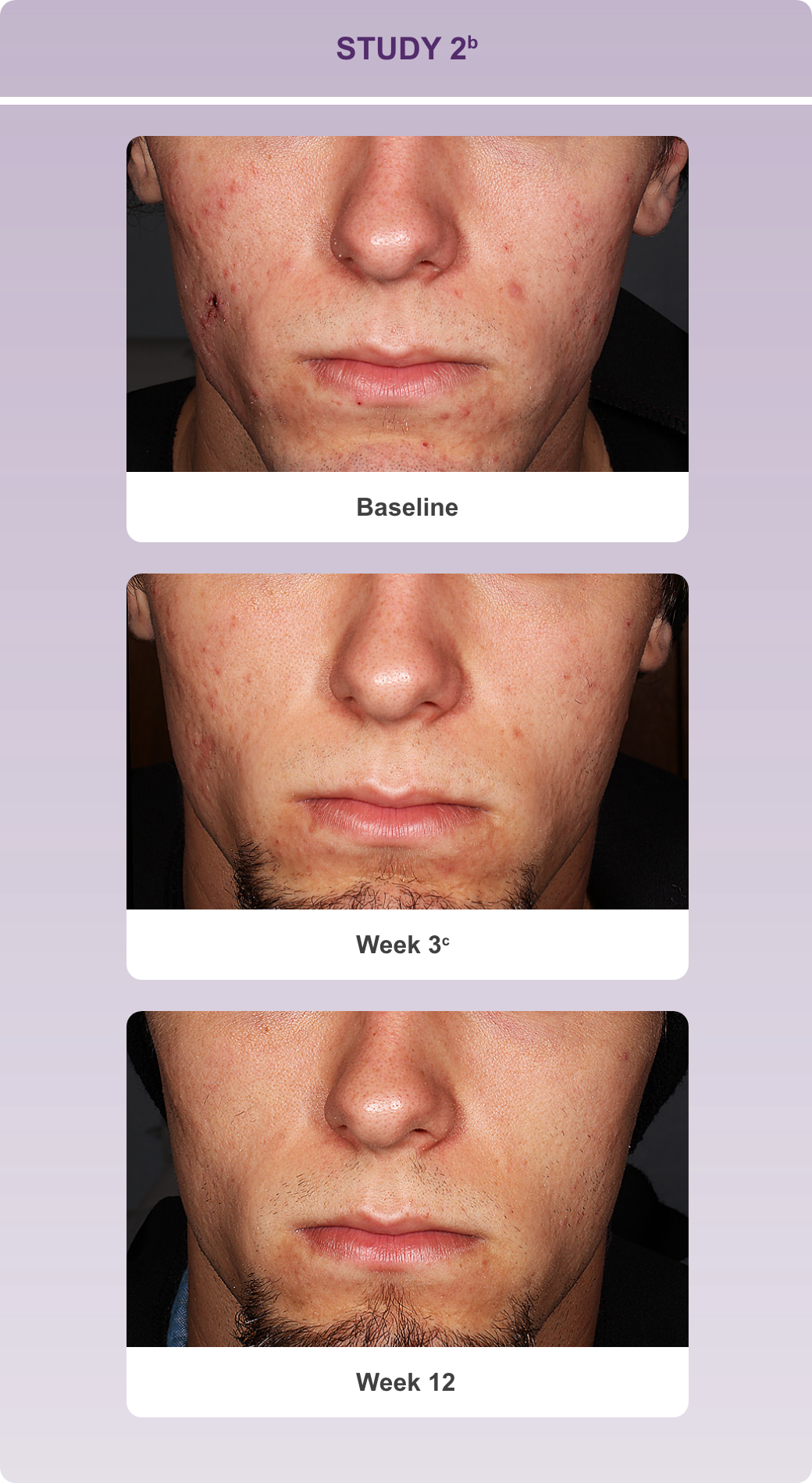 Series of progressive reduction in lesions on a subject's face at baseline, week 3 and week 12 in study 2