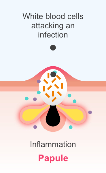 A papule, showing white blood cells attacking an infection