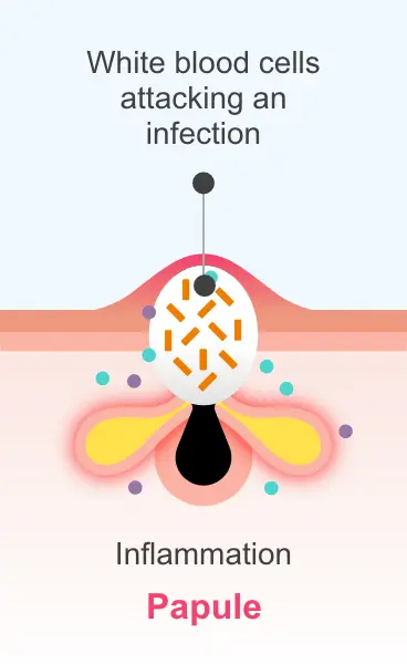 A papule, showing white blood cells attacking an infection
