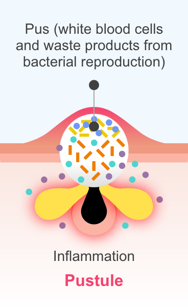 A pustule, showing white blood cells and waste products from bacterial reproduction)