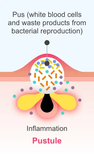 A pustule, showing white blood cells and waste products from bacterial reproduction)