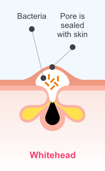 A whitehead, showing bacteria in a pore, which is sealed with skin